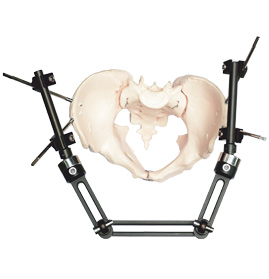 exHEAL Pelvic Fixator System exHEAL Pelvic Fixator System